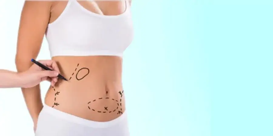 prepare for liposculpture